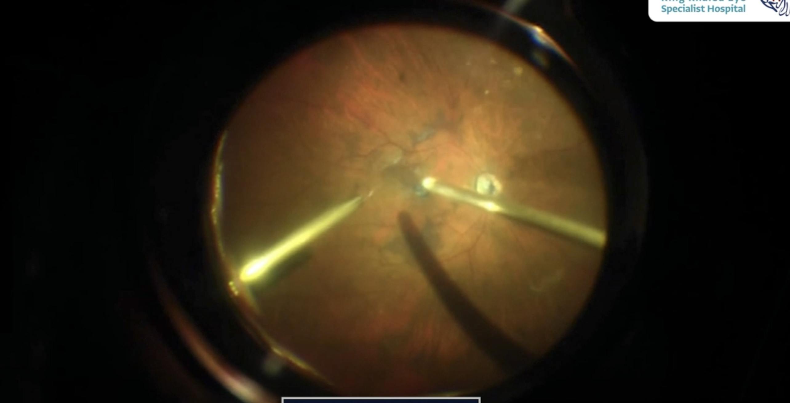 Cataract With Persistent Full Thickness Macular Hole Eyetube